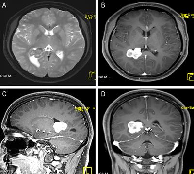 Lateral ventricle ectopic schwannoma: Case report and literature review